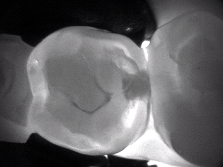 You are currently viewing Why Do I Get So Many Cavities?
