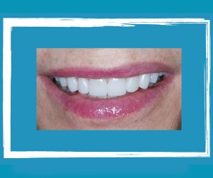 Read more about the article Same day Porcelain Crowns and Veneers in San Diego