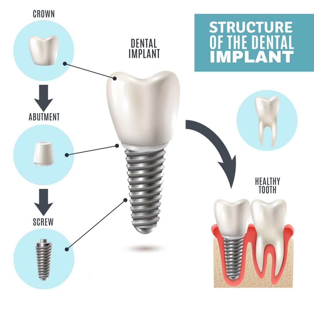 dental implant explanation from Lifetime Smiles of Escondido